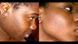Un visage sans tâches c'est possible #Tache #Visage #bouton #skinroutine #skincare #beauty